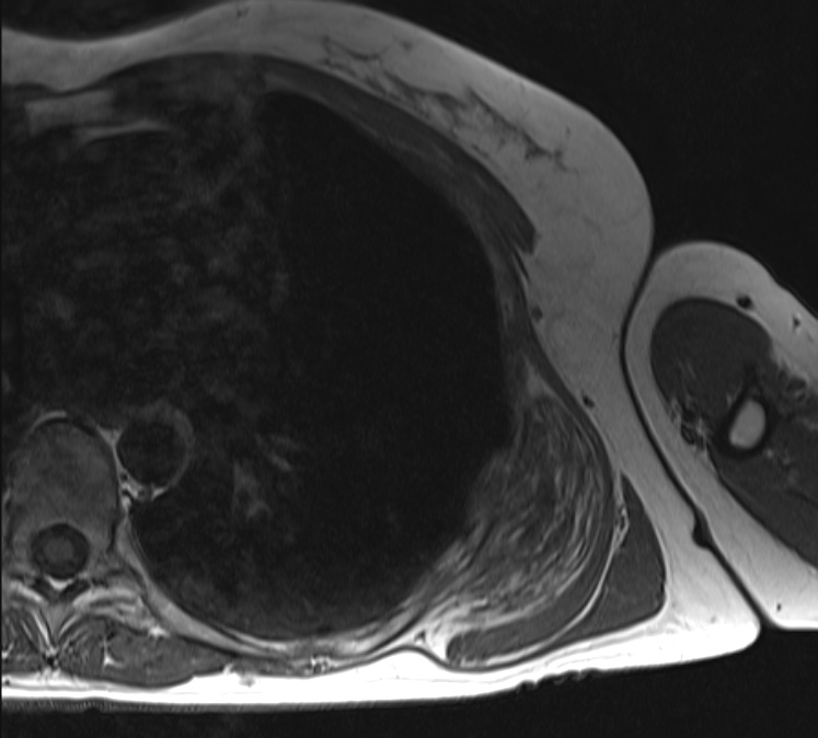 Figure 3 for case Bilateral elastofibroma dorsi
